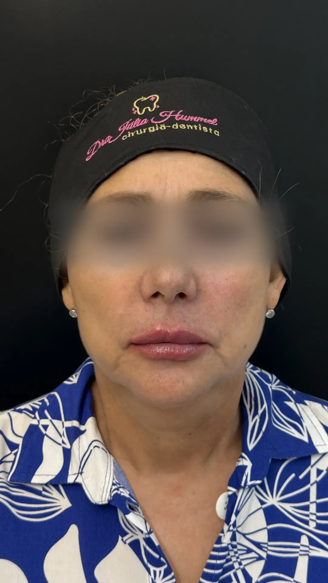Resultado de tratamento odontológico e estético realizado pela Dra. Júlia Hummel