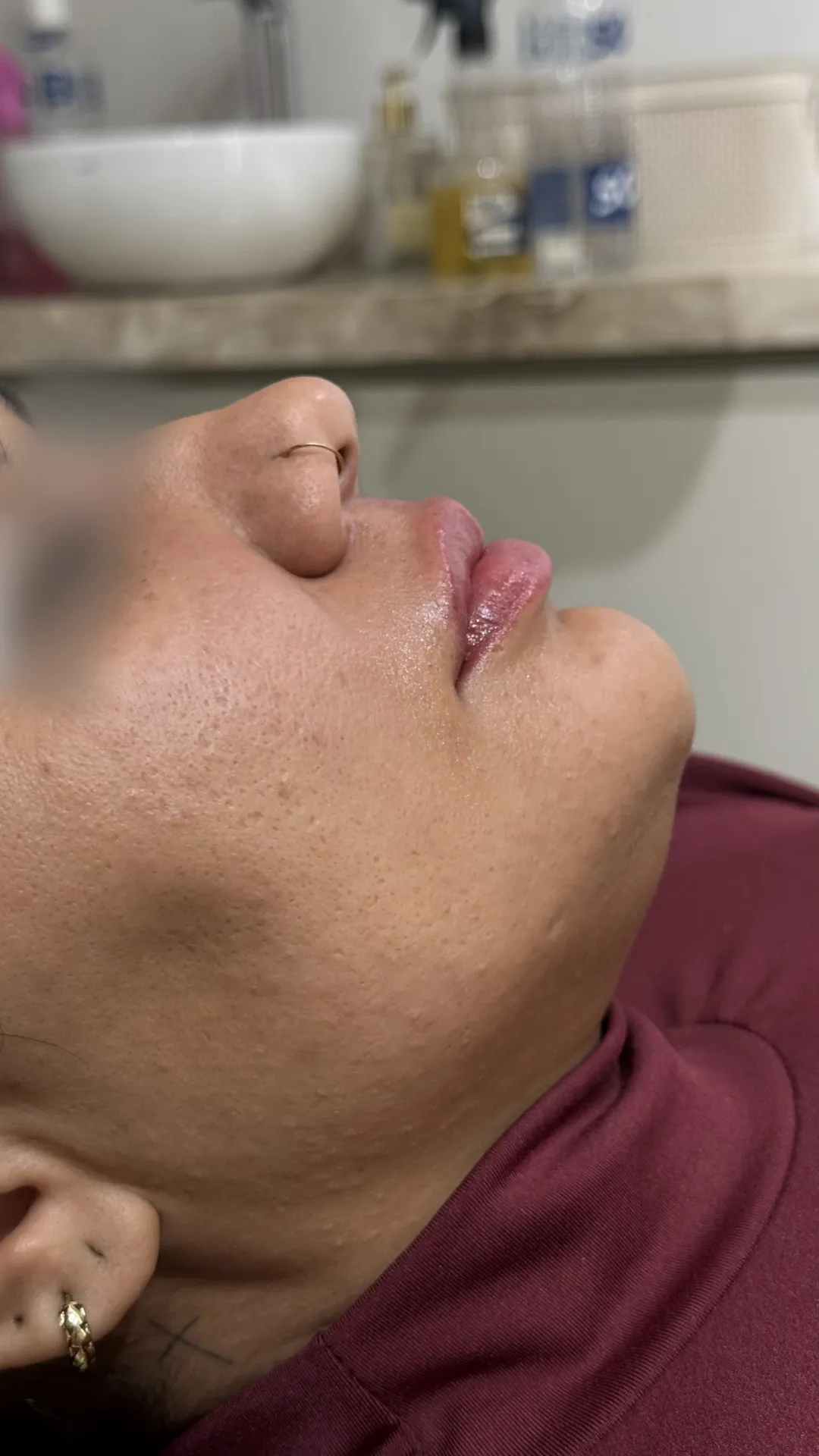 Resultado de tratamento odontológico e estético realizado pela Dra. Júlia Hummel